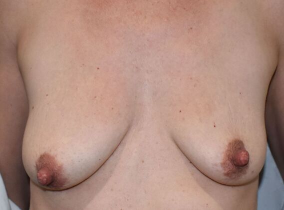 Breast Augmentation w/ Lift Case 509 - Before