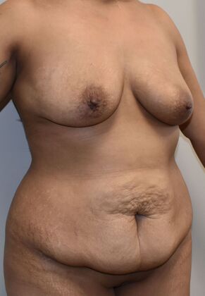 Mommy Makeover: Case 239 - Before