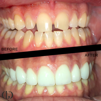 Smile Makeover: Case 11