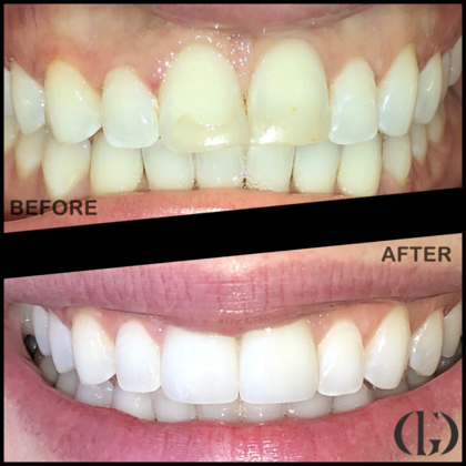 Smile Makeover Case 12