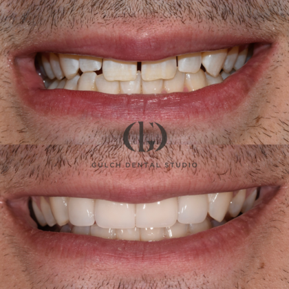 Smile Makeover Case 13