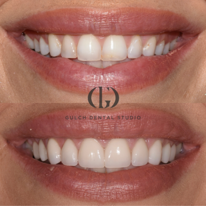 Smile Makeover Case 14