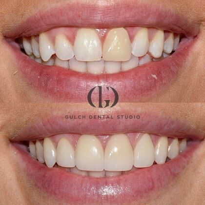 Smile Makeover Case 15