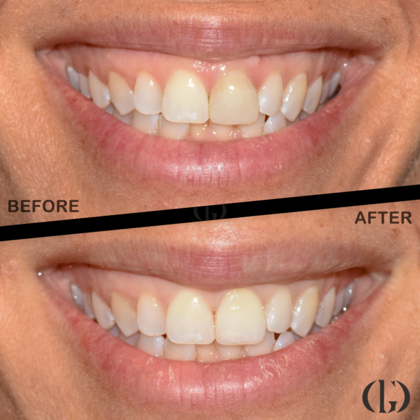 Smile Makeover: Case 16