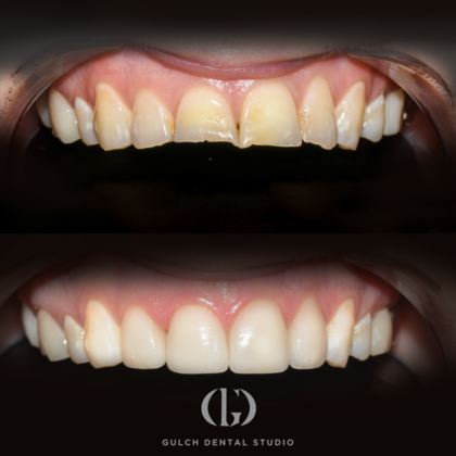 Smile Makeover: Case 17