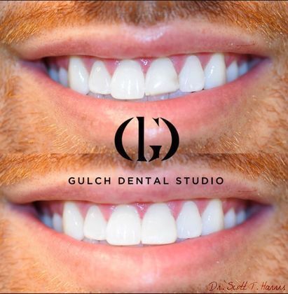 Smile Makeover: Case 18