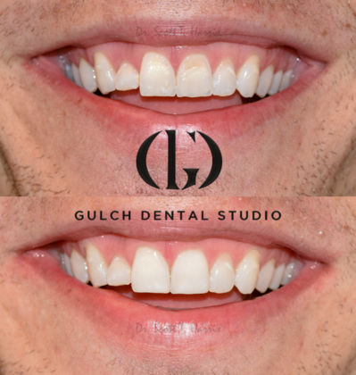 Smile Makeover Case 19