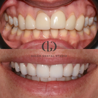 Smile Makeover: Case 20