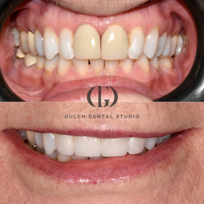 Smile Makeover Case 21