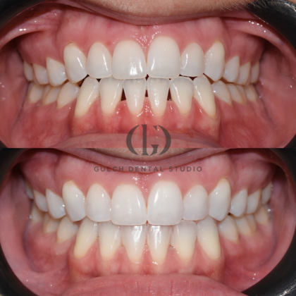 Smile Makeover: Case 22