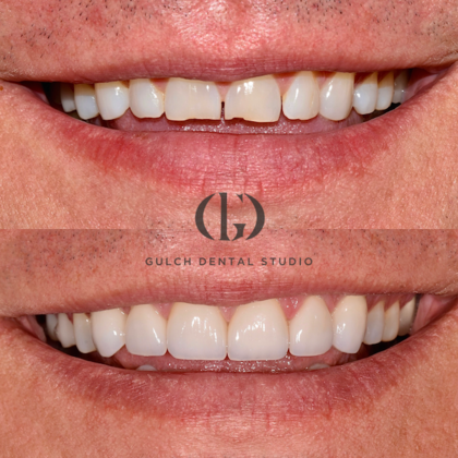 Smile Makeover: Case 26
