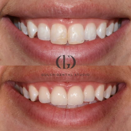 Smile Makeover Case 27