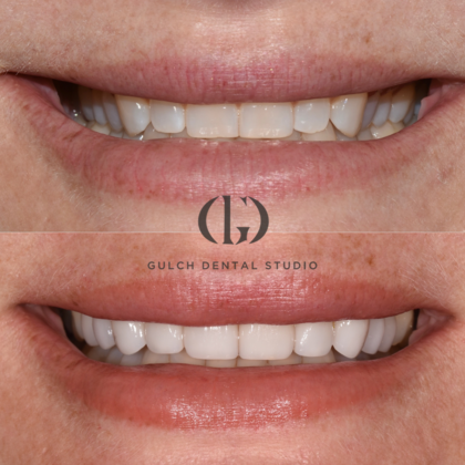 Smile Makeover: Case 28