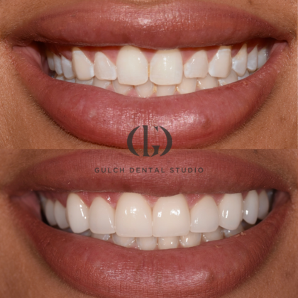 Smile Makeover: Case 29