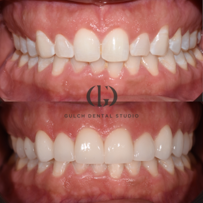 Smile Makeover Case 30