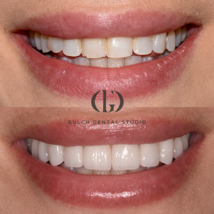 Smile Makeover Case 31