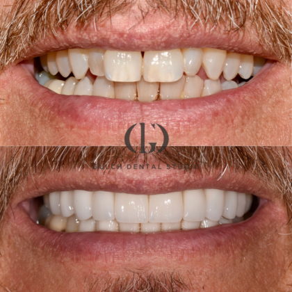 Smile Makeover: Case 32