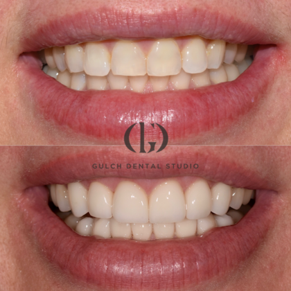 Smile Makeover: Case 33