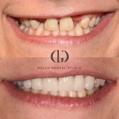 Smile Makeover Case 4