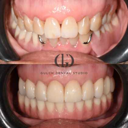 Smile Makeover Case 34