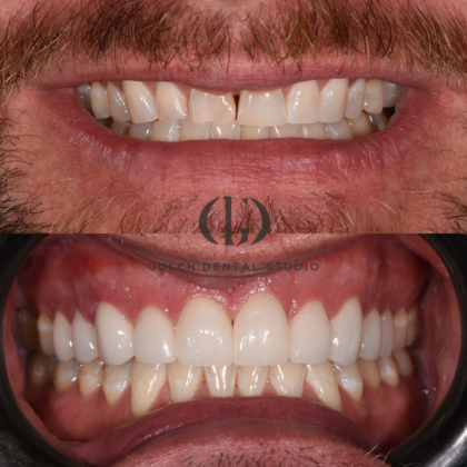 Smile Makeover: Case 35