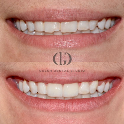 Smile Makeover: Case 36