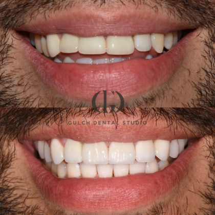 Smile Makeover Case 37