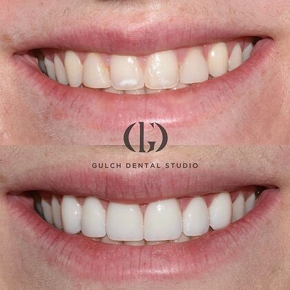 Smile Makeover Case 39