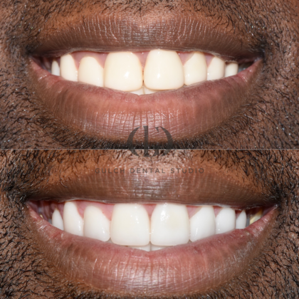 Smile Makeover Case 40