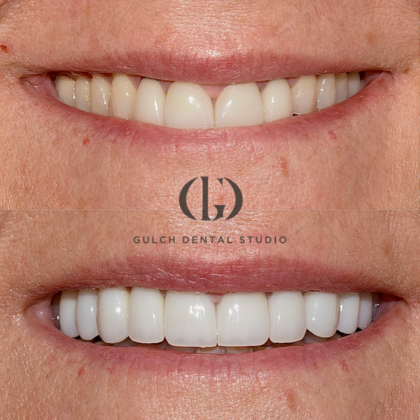 Smile Makeover Case 41