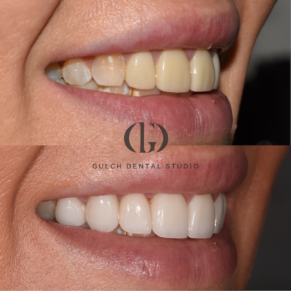 Smile Makeover Case 42