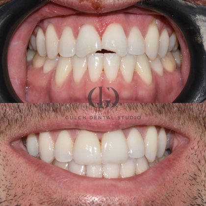 Smile Makeover: Case 43
