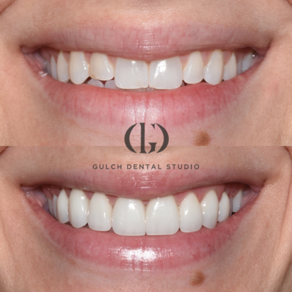 Smile Makeover: Case 44