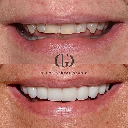 Smile Makeover: Case 45