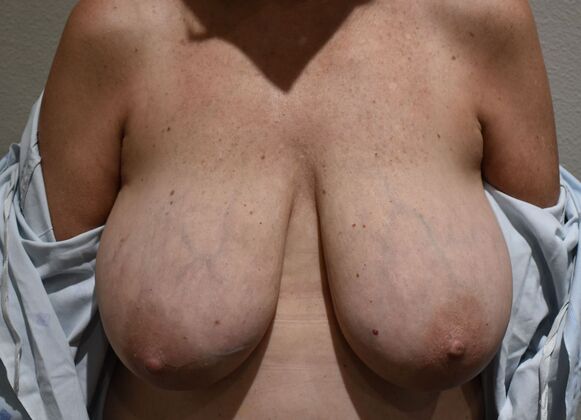 Breast Reduction Case 139 - Before