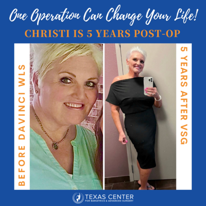 Transformation Tuesday Christi is 5 Years Post-Op!