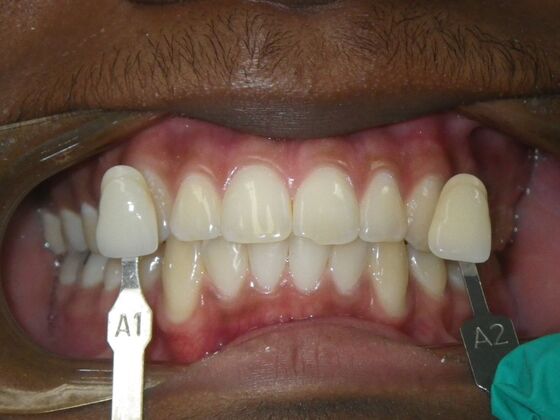 In-Office Zoom Whitening: Case 4 - Before