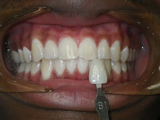 In-Office Zoom Whitening Case 4 - After