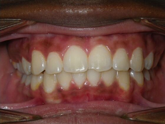In-Office Zoom Whitening Case 4 - Before