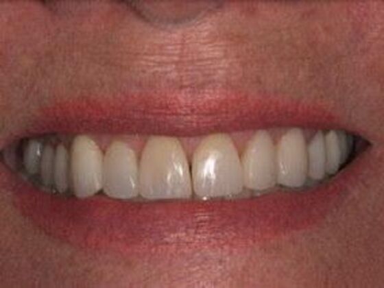 Full Mouth Rehabilitation : Margo - Before
