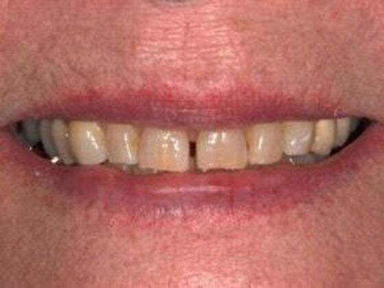 Full Mouth Rehabilitation : Margo - After