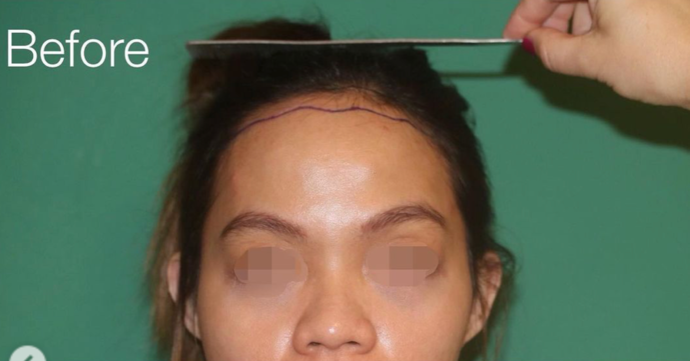 Hairline Lowering Surgery: Case 17 - Before