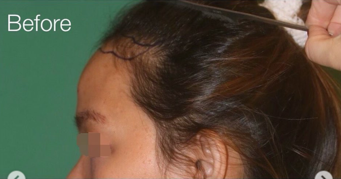 Case 17 - Forehead Reduction / Hairline Lowering Surgery - Before and After Gallery Case 17 - Forehead Reduction / Hairline Lowering Surgery - Before and After Gallery