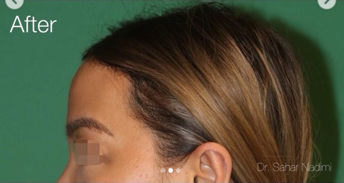 Hairline Lowering Surgery: Case 17 - After