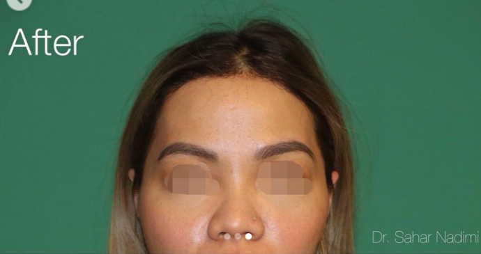 Hairline Lowering Surgery: Case 17 - After