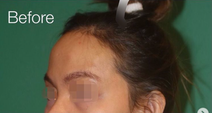 Case 17 Forehead Reduction Hairline Lowering Surgery Before And After Gallery