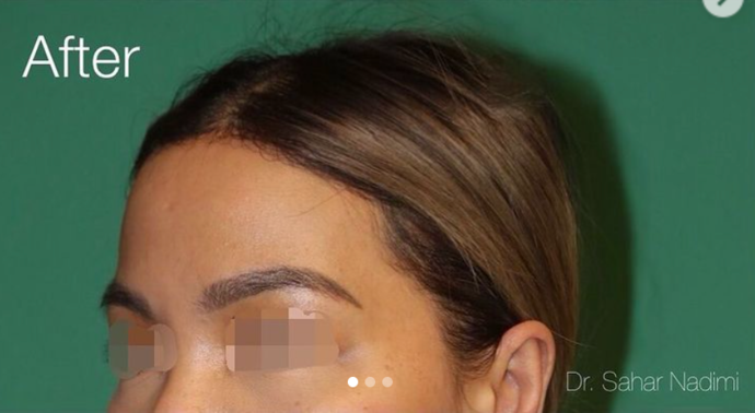 Hairline Lowering Surgery: Case 17 - After