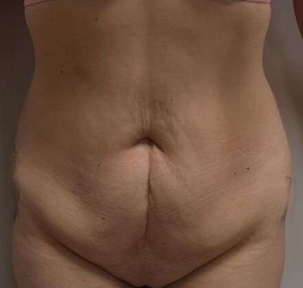 Tummy Tuck (Abdominoplasty): Case 369 - Before