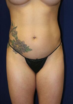 Abdominal Etching : Case 2 - Before