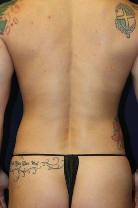 Abdominal Etching : Case 2 - Before